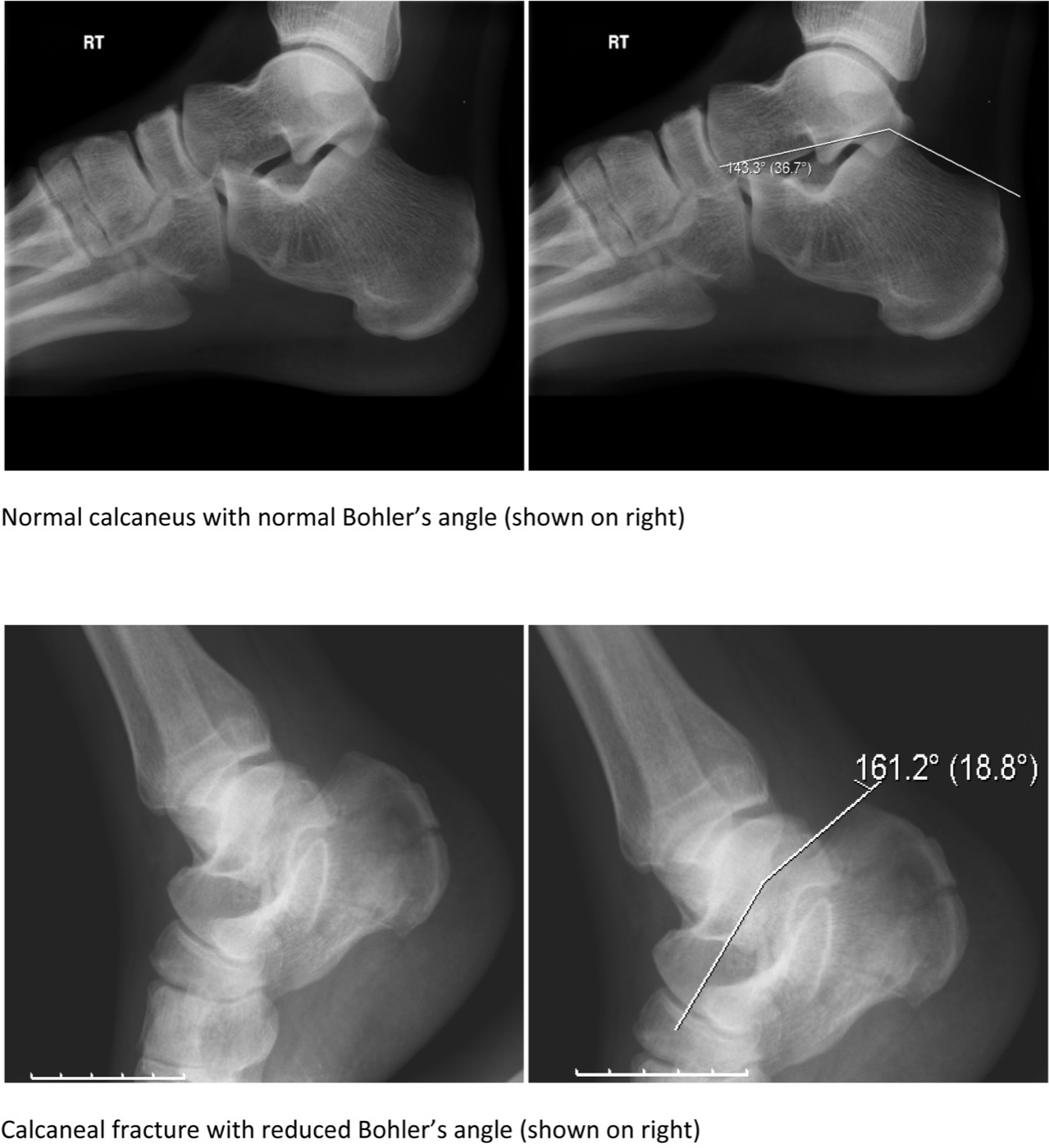 Figure 25. Boehler’s angle on the lateral calcaneal radiograph: normal (top) versus a calcaneal fracture with a reduced angle (bottom). Gilo1969, CC BY-SA 3.0, via Wikimedia Commons.