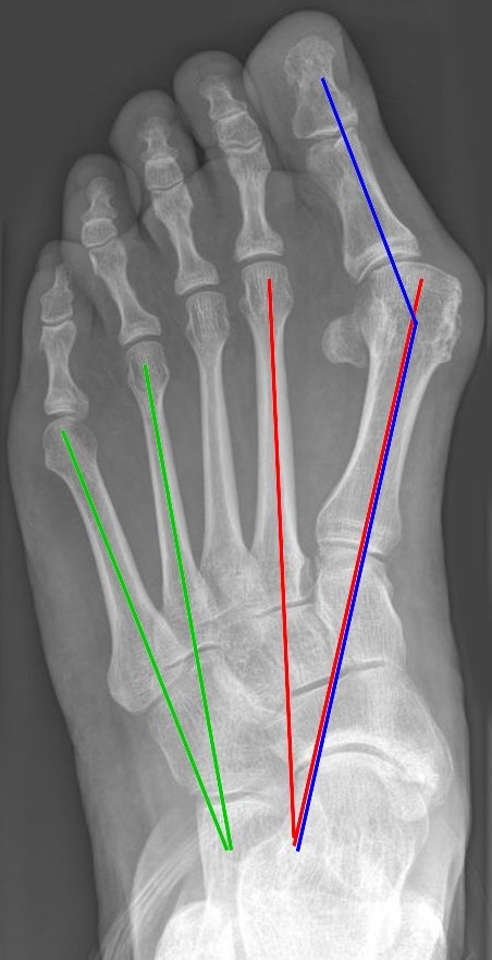 Figure 27. Weight-bearing radiograph of hallux valgus, with the hallux valgus angle (blue) and the intermetatarsal angles (red and green) measured. Jmarchn, CC BY-SA 3.0, via Wikimedia Commons.
