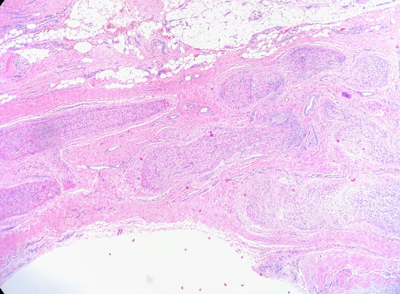 Figure 29. Histology of a Morton (plantar interdigital) neuroma, showing the perineural fibrosis of the interdigital nerve, H\&E stain. Ed Uthman, CC BY 2.0, via Wikimedia Commons.
