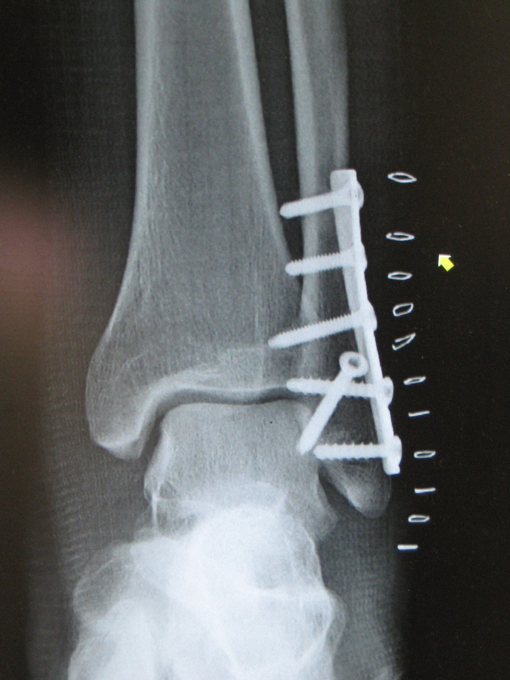 Figure 7. Postoperative ankle ORIF: a lateral (distal fibular) plate with screws and medial-side screw fixation, restoring fibular length and a congruent mortise. Radiograph by James Heilman, MD, CC BY-SA 3.0, via Wikimedia Commons.