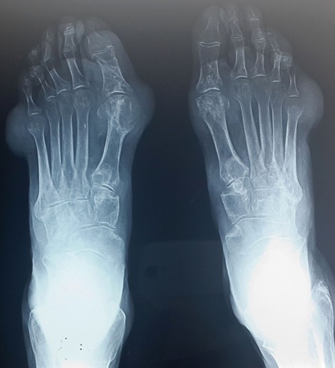 Chronic tophaceous gout (foot radiograph). Periarticular “punched-out” erosions, prominent at the first MTP joints. Image: N. Aradoini et al., CC BY, via Wikimedia Commons.