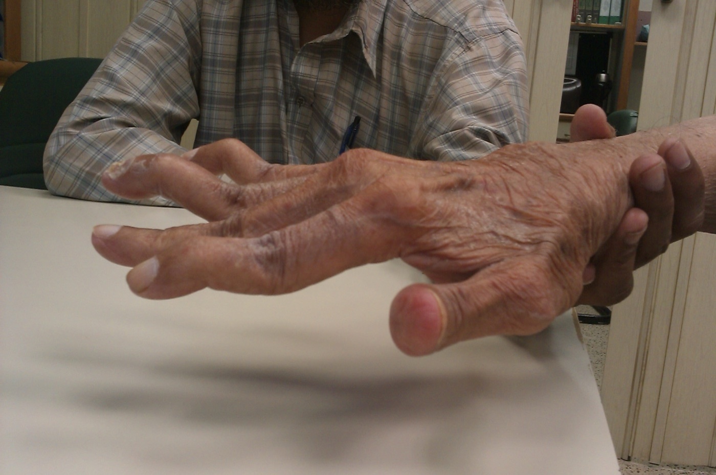 Swan-neck deformity (PIP hyperextension with DIP flexion) in a hand affected by rheumatoid arthritis. Image: Phoenix119, CC BY-SA 3.0, via Wikimedia Commons.