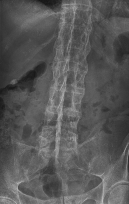 “Bamboo spine” of ankylosing spondylitis. AP lumbar radiograph with flowing marginal syndesmophytes bridging the vertebral bodies. Image: Stevenfruitsmaak, CC BY-SA 3.0, via Wikimedia Commons.