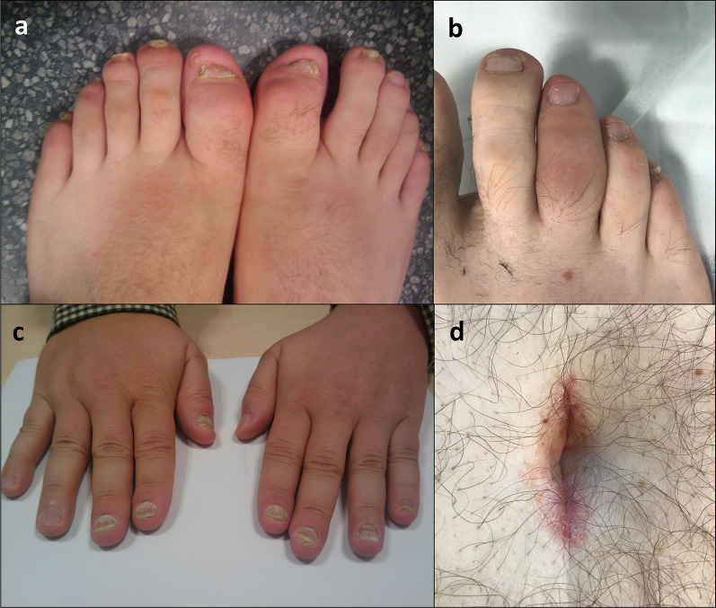 Psoriatic arthritis: nail disease and dactylitis. Nail pitting and onychodystrophy with a “sausage digit.” Crespo-Rodríguez et al., Insights Imaging 2021, CC BY 4.0.