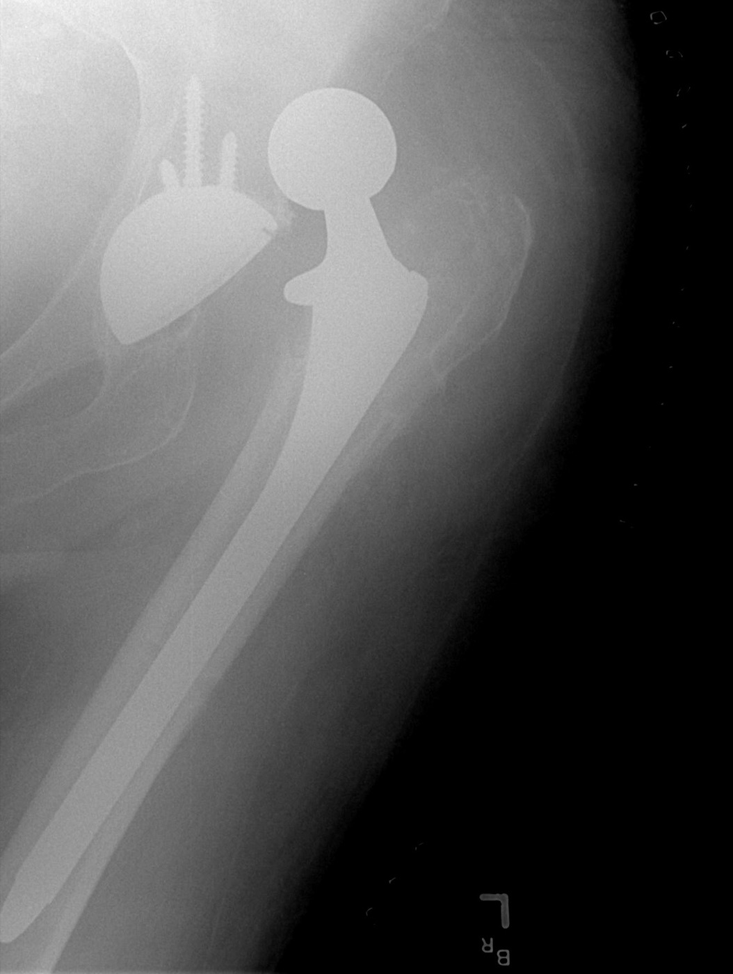 Figure 11. Dislocation of a total hip prosthesis: the femoral head lies outside the acetabular cup. Source: Bill Rhodes, via Wikimedia Commons, CC BY 2.0.