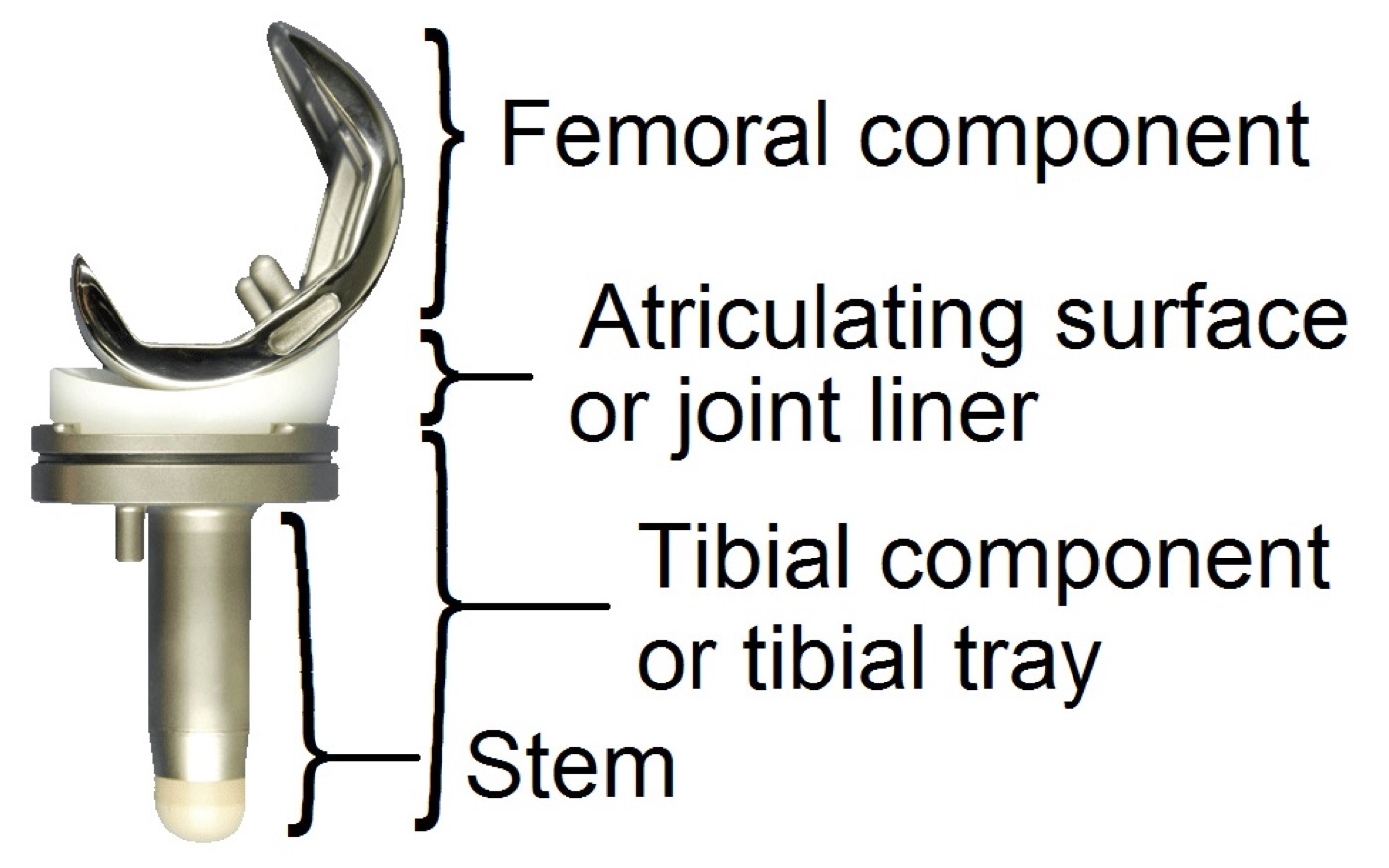 Figure 13. Components of a total knee replacement: femoral component, polyethylene insert (bearing), and tibial tray. Source: Graichen / Mikael Häggström, via Wikimedia Commons, CC BY 3.0.