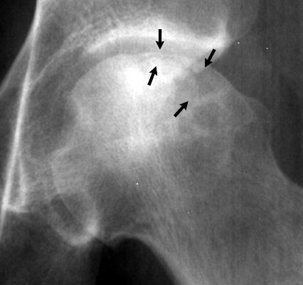 Antero-posterior hip with the subchondral crescent sign (arrows) - a lucent subchondral fracture line beneath the articular surface, marking the pre-collapse-to-collapse boundary. (Mikael Häggström, after OrthopaedicsOne, Wikimedia Commons; CC BY-SA 3.0.)