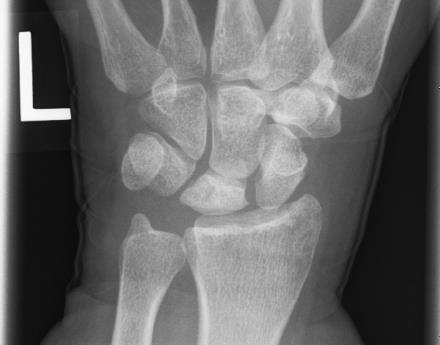 Postero-anterior wrist radiograph in Kienböck disease: the lunate is sclerotic (denser) relative to the adjacent carpal bones. (User Muzichick, Wikimedia Commons; CC BY-SA 4.0.)