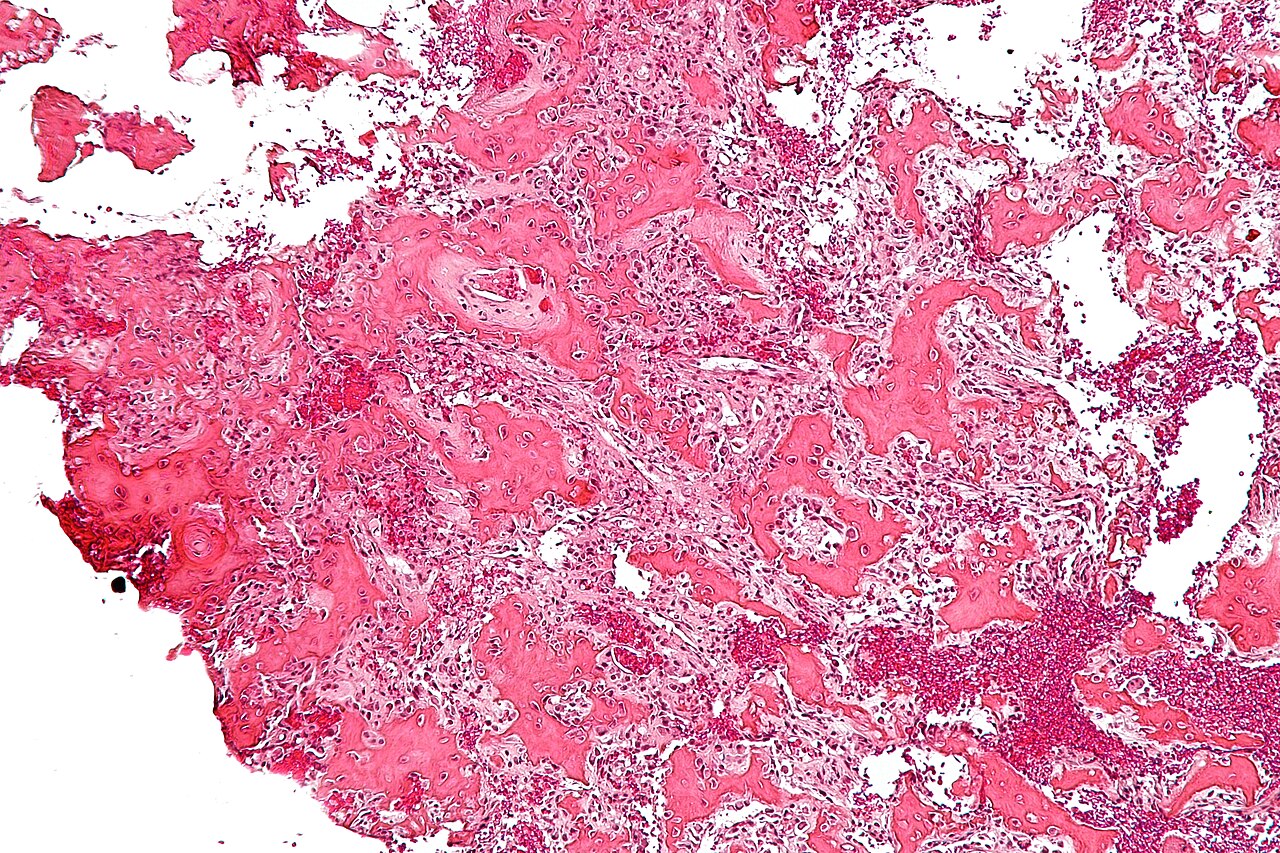 Figure 3. Osteoid osteoma - nidus of interconnecting woven-bone/osteoid trabeculae rimmed by osteoblasts in a vascular stroma (H&E). Nephron, CC BY-SA 3.0, Wikimedia Commons.