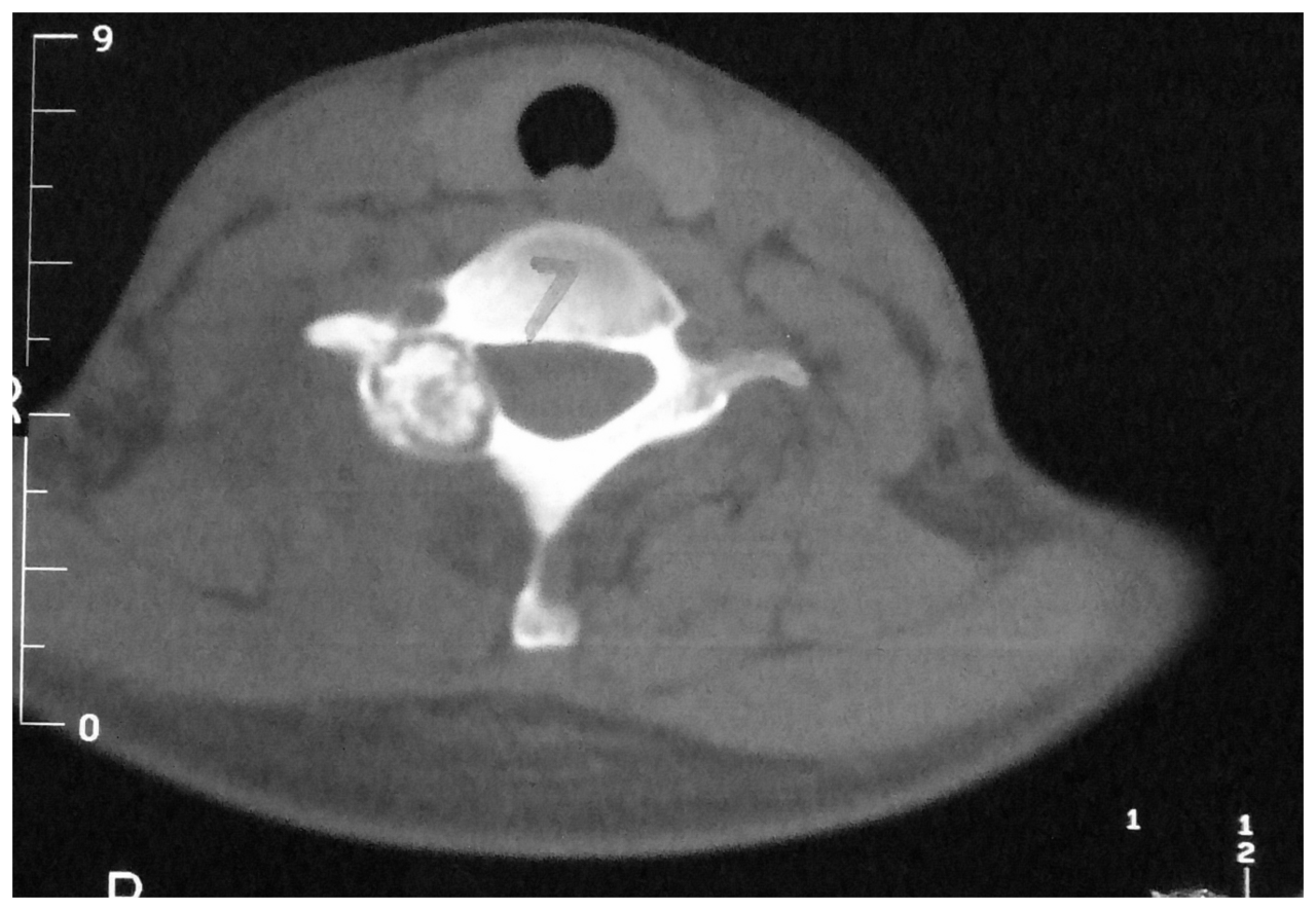 Figure 4. Osteoblastoma - expansile, partly mineralised lesion of the C7 posterior elements (CT). Li & Zhao et al., PLOS ONE 2013, CC BY-SA 4.0, Wikimedia Commons.