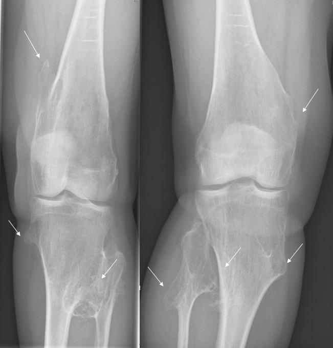 Figure 7. Hereditary multiple exostoses - multiple metaphyseal exostoses with metaphyseal undermodelling (both knees). Bovée, Orphanet J Rare Dis 2008, CC BY-SA 3.0 NL, Wikimedia Commons.