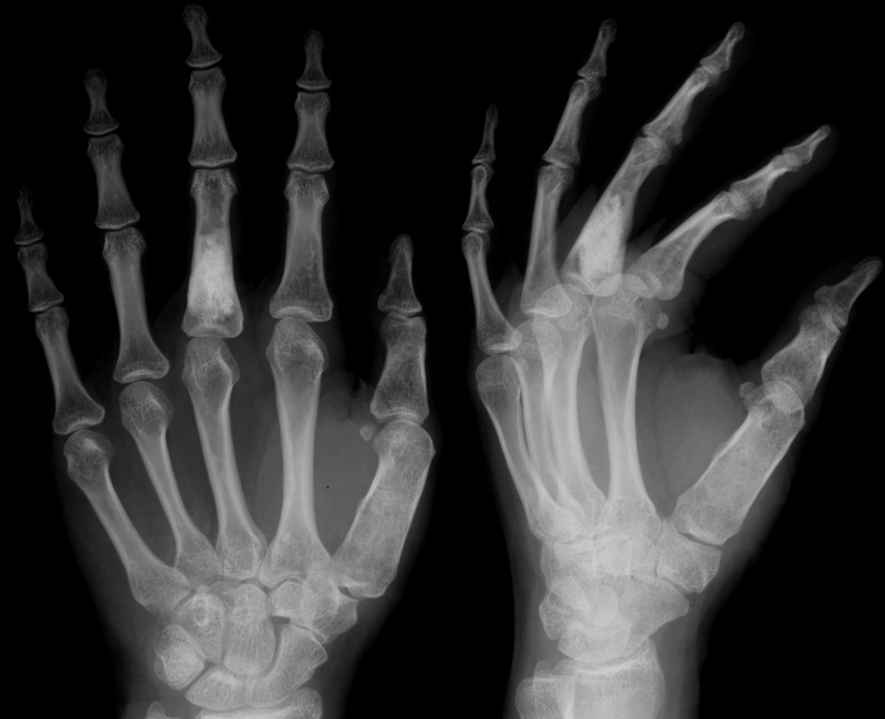 Figure 8. Enchondromatosis (Ollier disease) - multiple expansile lytic enchondromas of the phalanges and metacarpals. Hellerhoff, CC BY-SA 3.0, Wikimedia Commons.