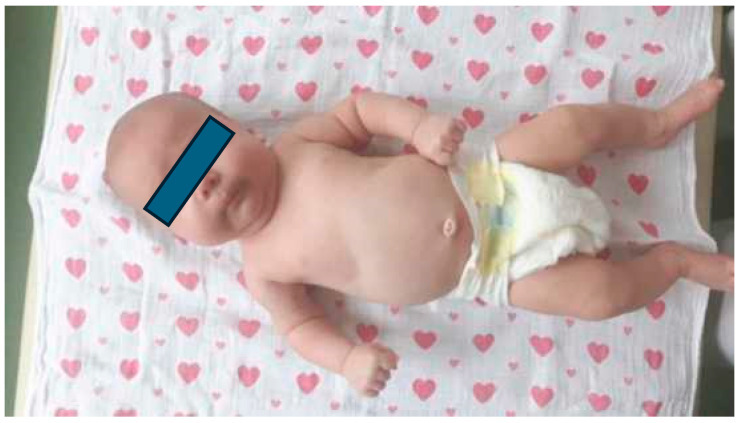 Figure 9. Infant with left congenital muscular torticollis, showing the characteristic “C-shape” posture of head tilt with contralateral chin rotation. Credit: From Płomiński et al. (2023), Healthcare (MDPI), PMC10778664, Fig. 1, CC BY 4.0.