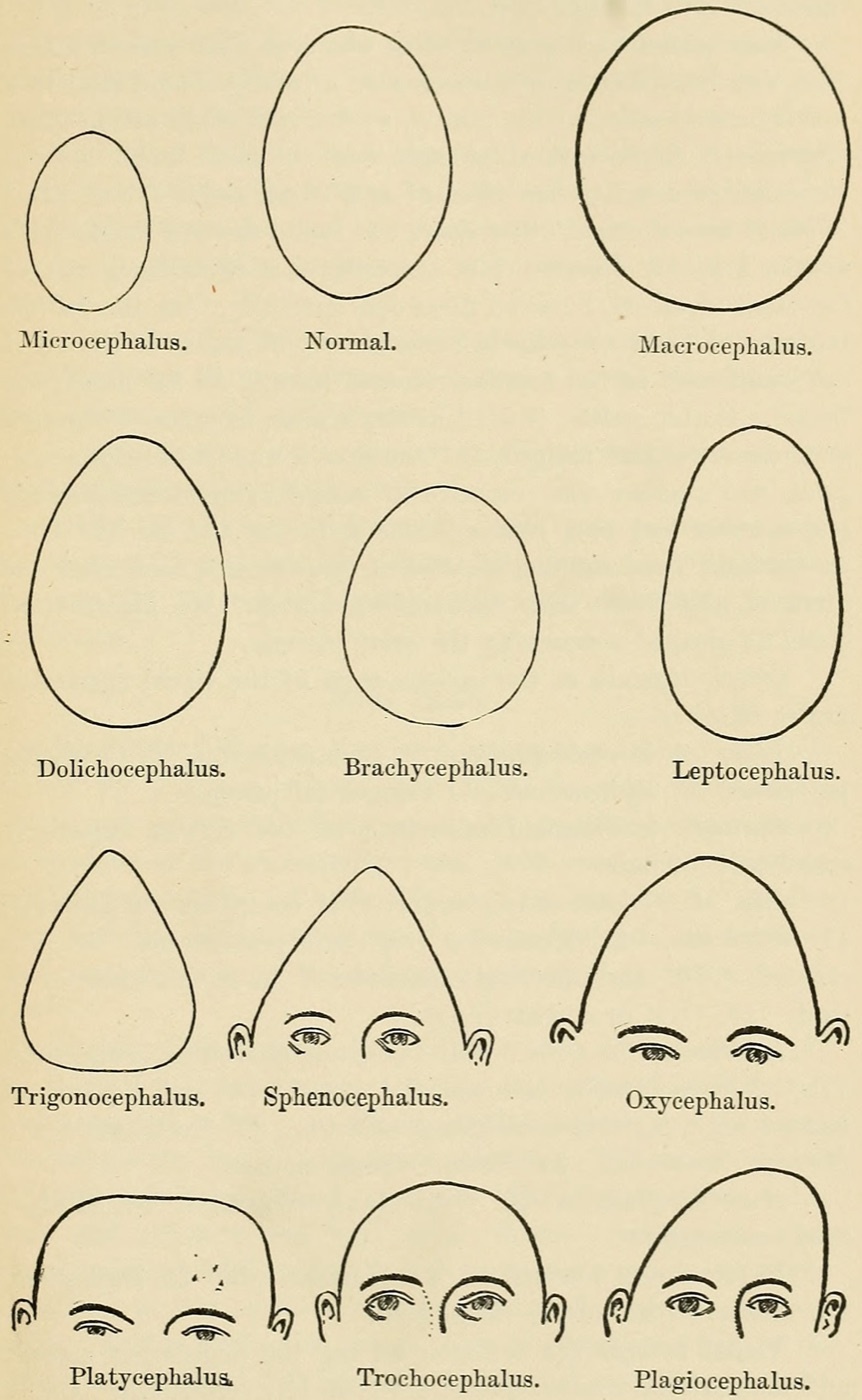 Figure 11. Line diagram of cranial-shape deformities, including plagiocephaly, the asymmetric head shape that accompanies and complicates congenital muscular torticollis. Credit: E. Mendel / W. C. Krauss, “Types of Cranial Deformity,” public domain, via Wikimedia Commons.