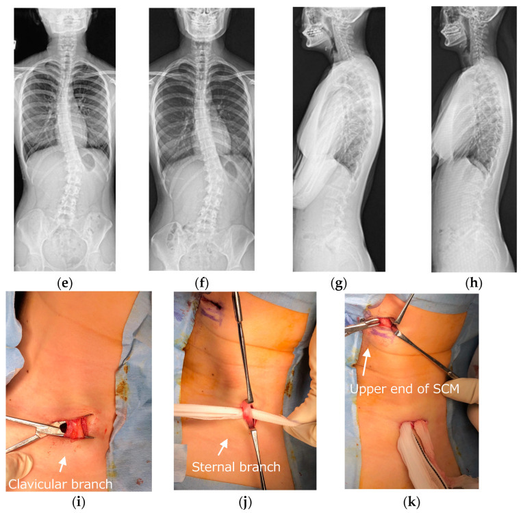 Figure 12. Intra-operative bipolar sternocleidomastoid release for neglected torticollis (panels i-k): the clavicular branch, sternal branch and upper end of the SCM are identified and divided. Credit: From Funao et al. (2023), J Clin Med (MDPI), PMC10780082, Fig. 3, CC BY 4.0.