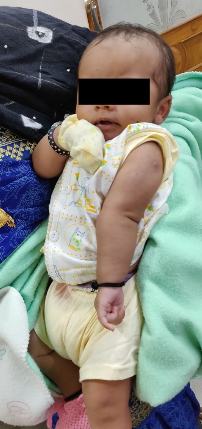 Figure 4. Erb-Duchenne palsy of the right arm in the “waiter’s tip” posture: shoulder adducted and internally rotated, forearm pronated. Credit: Rdabhi, via Wikimedia Commons, CC BY-SA 4.0.