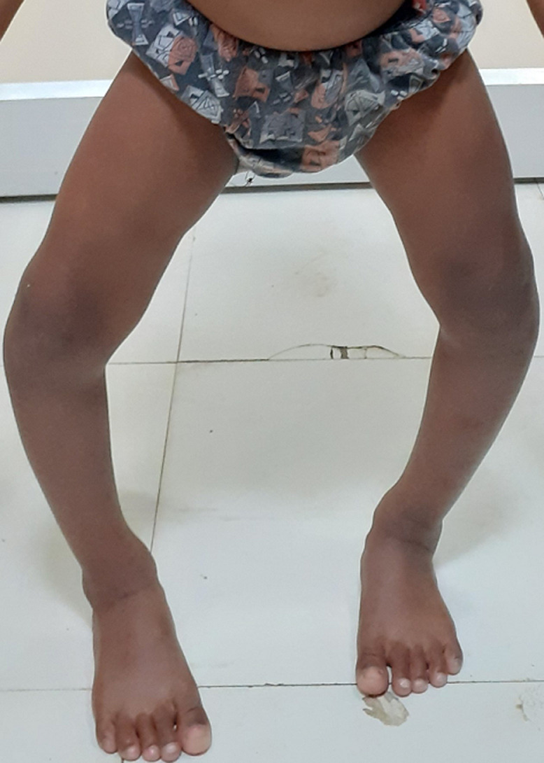 Clinical bow-leg (genu varum). Standing toddler with marked bilateral genu varum - the presentation that must be distinguished from physiologic bowing. Vagha K et al., Pan Afr Med J 2022;42:161, Fig. 1 (CC BY 4.0).