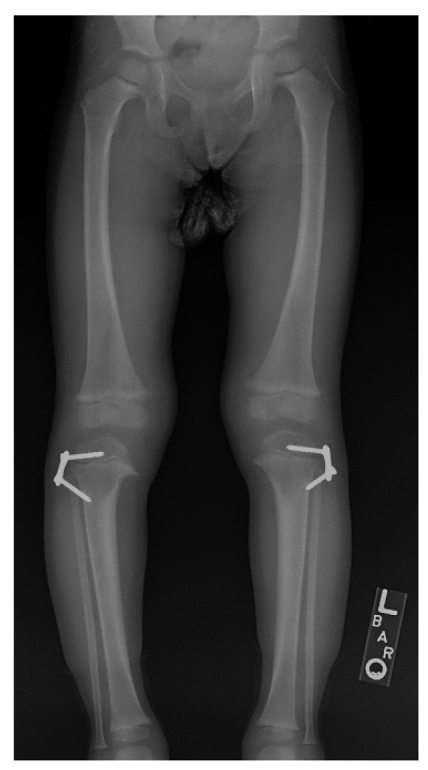 Guided growth. Lateral proximal-tibial tension-band (“8-plate”) plates tether the lateral physis to correct the varus gradually in a child with growth remaining. Robbins CA, Children (Basel) 2021;8(7):566, Fig. 12 (CC BY 4.0).