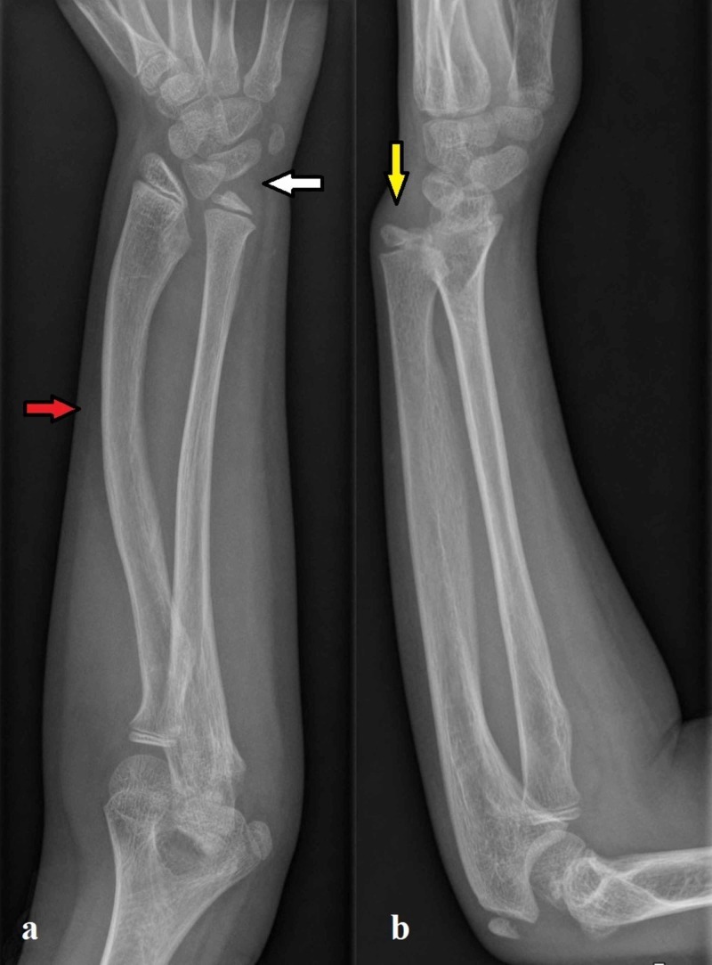 Madelung deformity - radiographic signs. (a) PA wrist: increased radial inclination, triangularisation of the carpus (white arrow) and a bowed, shortened radius (red arrow); (b) lateral wrist: volar tilt of the distal radius with dorsal subluxation of the ulnar head (yellow arrow). De Leucio A et al., Cureus 2020;12(2):e7100, Fig. 1 (CC BY).