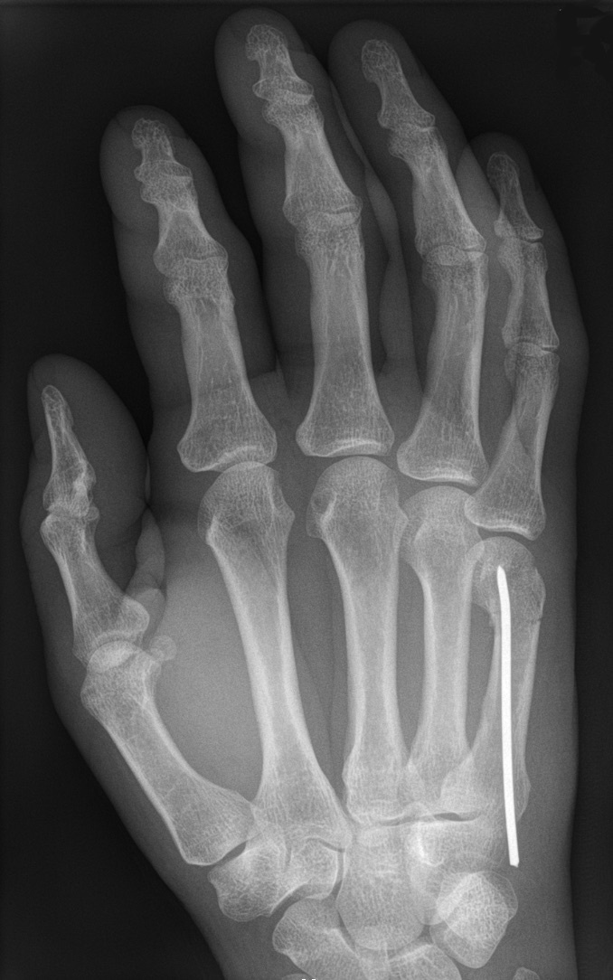 Figure 13. A little-finger metacarpal fracture after intramedullary K-wire fixation. Hellerhoff, CC BY-SA 3.0, via Wikimedia Commons.