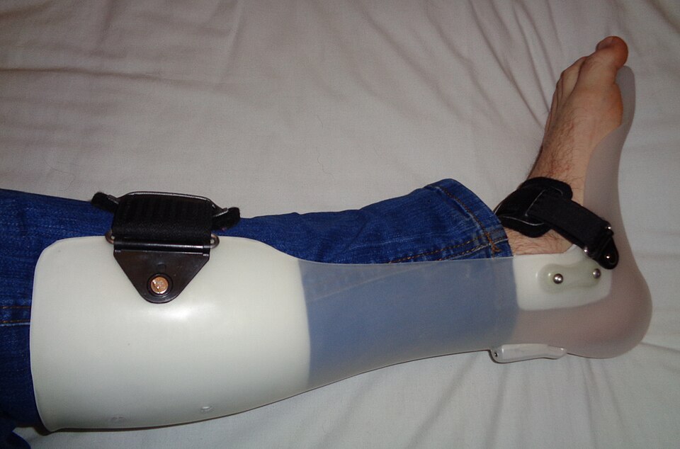 Ankle-foot orthosis (AFO). A hinged AFO with a calf shell, ankle joint and footplate, of the kind used to control dynamic equinus and a swing-phase drop foot. Photo: Pagemaker787, via Wikimedia Commons (CC BY-SA 4.0).