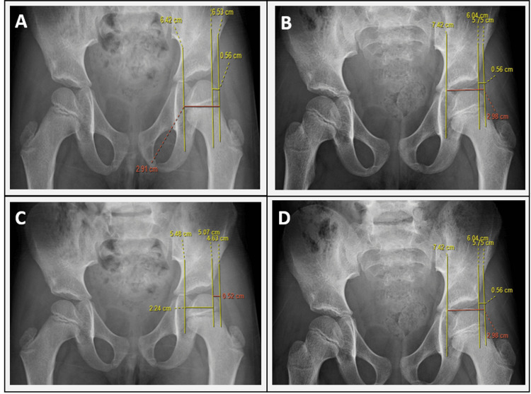 Reimers migration percentage (MP). Antero-posterior pelvis with the construction drawn: Hilgenreiner’s horizontal line, the vertical Perkins’ lines from the lateral acetabular margins, and the distances (A = head lateral to Perkins’ line, B = head width) giving MP = A/B × 100%; the right hip is migrating laterally. From Sajeev et al., Cureus 2025;17(12):e98870 (CC BY 4.0).