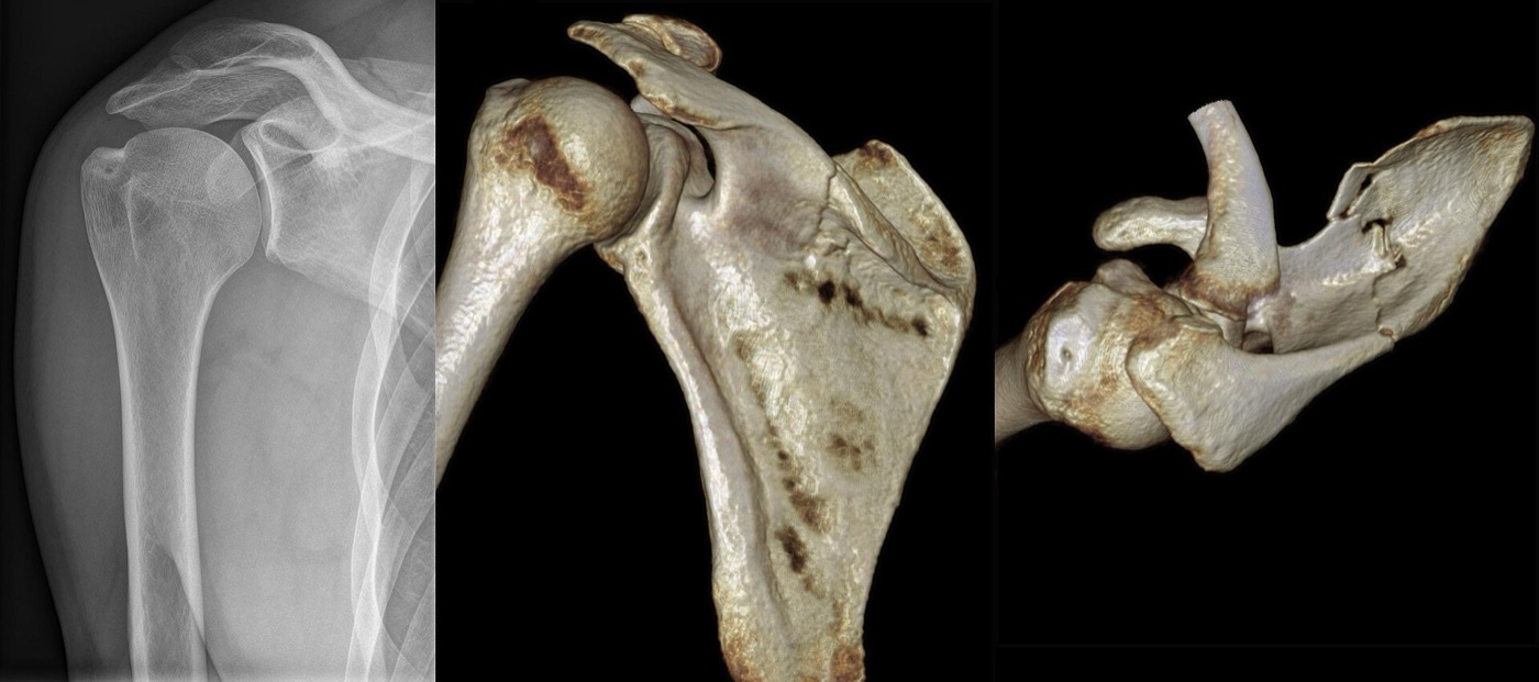 Figure 10. Comminuted scapular fracture: AP radiograph (left) and 3D CT volume rendering (centre and right), which is the gold-standard study. Source: Hellerhoff, via Wikimedia Commons, CC BY-SA 3.0.