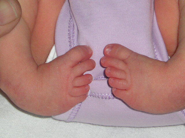 Bilateral congenital talipes equinovarus in a newborn: both feet are inverted and adducted, with the soles turned toward the midline. (Brachet Youri, Wikimedia Commons; CC BY-SA 3.0.)