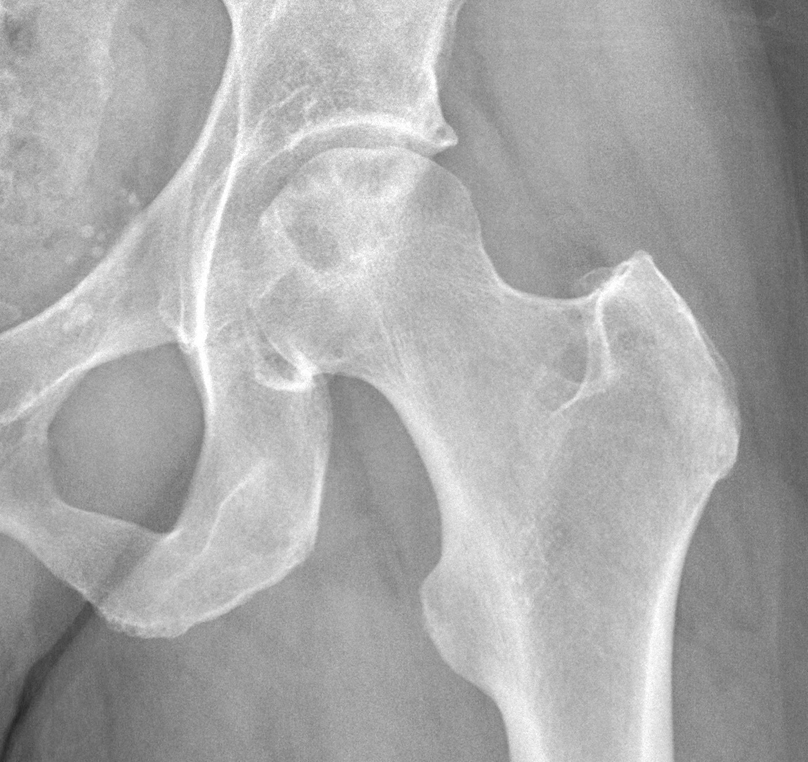 Figure 2. Avascular necrosis of the femoral head on a hip radiograph (subchondral lucency and an irregular head surface), a recognised late complication of a femoral-neck fracture. Source: Mikael Häggström, M.D., via Wikimedia Commons, CC0 1.0.