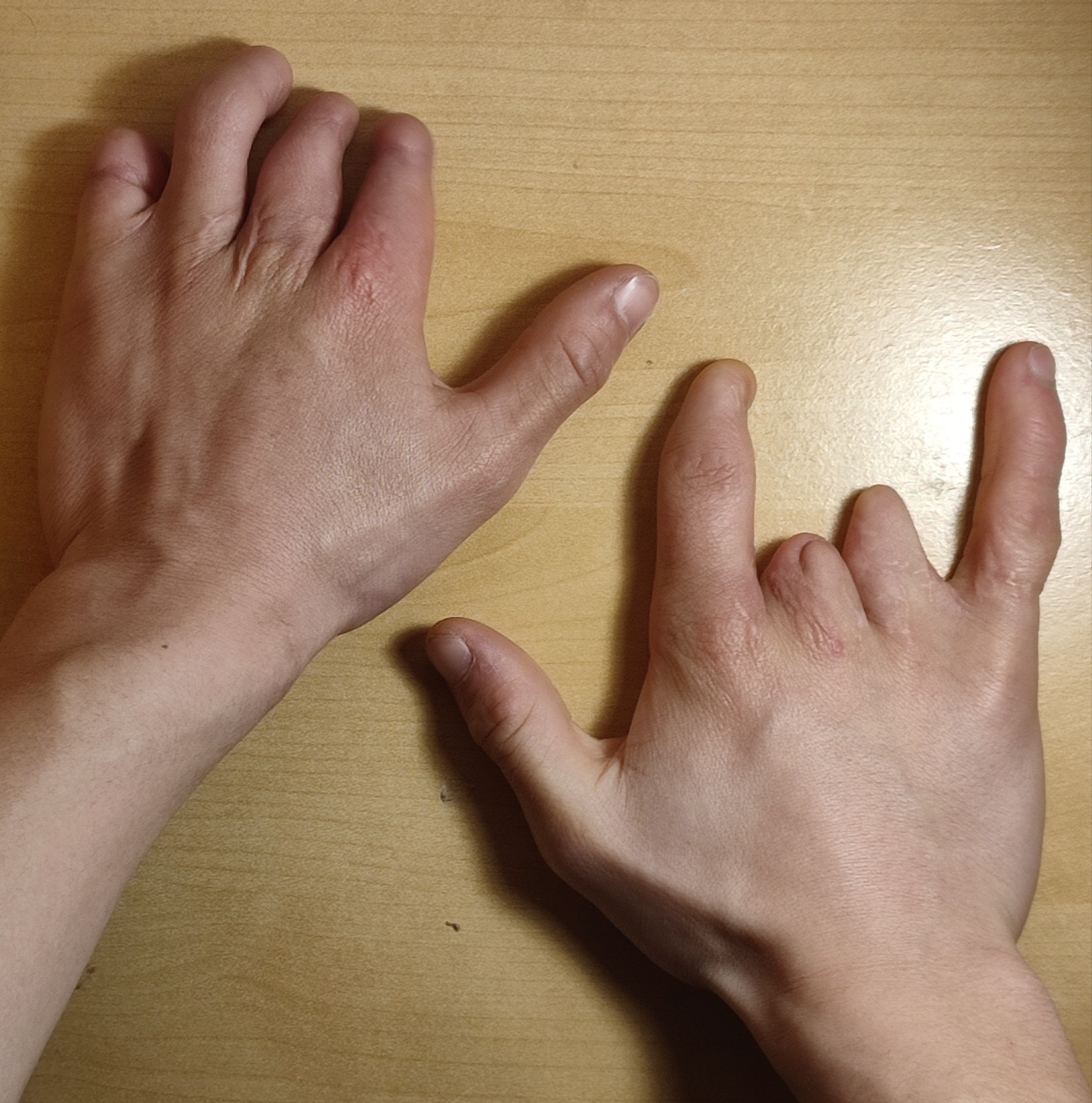 Constriction-ring (amniotic-band) syndrome: foreshortened central digits with stumps and basal acrosyndactyly. (Fyrosth, Wikimedia Commons; CC0.)