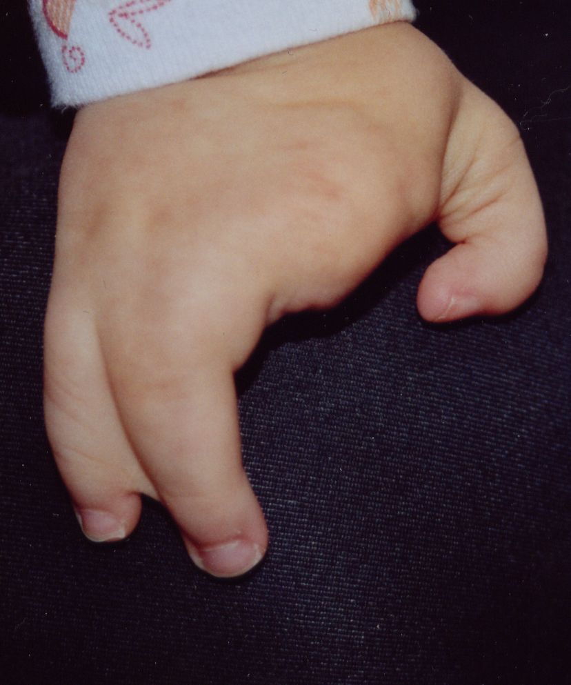 Typical cleft hand (ectrodactyly) in a one-year-old: a central V-shaped cleft divides the hand. (Aurélie & Sylvain Mulard, Wikimedia Commons; CC BY-SA 3.0.)