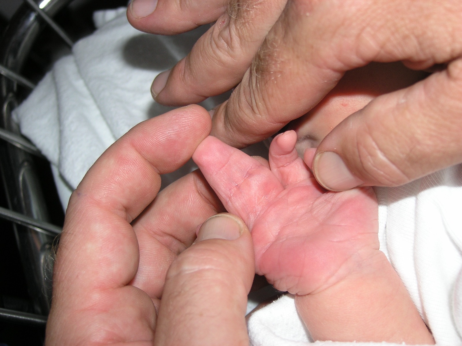 Complete complex syndactyly of a newborn hand: two central fingers are fused into a single soft-tissue mass sharing one nail. (Wikimedia Commons; public domain.)