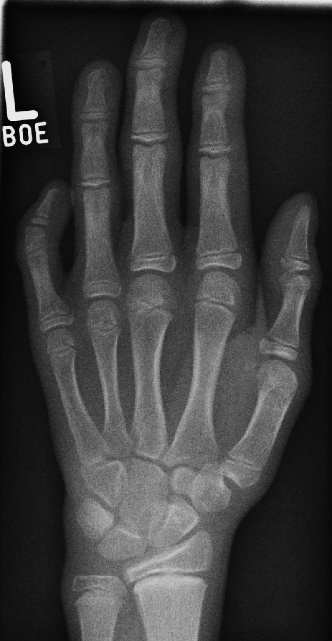Radiograph of little-finger clinodactyly with a short middle phalanx (brachymesophalangy) and radial angulation. (Tomograph, Wikimedia Commons; CC BY-SA 3.0.)