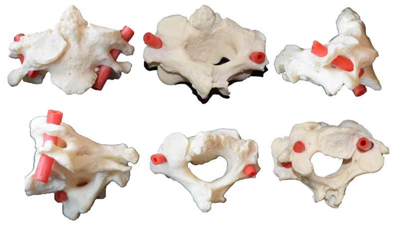 Cervical block vertebra (osteological specimen). Six views of congenitally fused C2-C3 vertebrae - the bony substrate of Klippel-Feil failure of segmentation; the red tubing marks the course of the vertebral artery. Tubbs RS et al., Cureus 2018;10:e3038, Fig. 1 (CC BY 3.0).