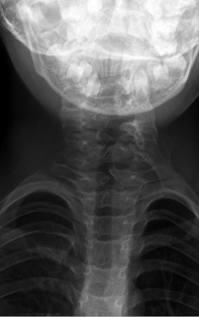 Sprengel deformity (congenital high scapula). Antero-posterior cervico-thoracic radiograph of an 8-month-old in a documented case of Sprengel deformity with an omovertebral bone (os omocervicale) bridging the scapula to the cervical spine. Hellerhoff, Wikimedia Commons (CC BY-SA 4.0).