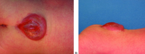 Lumbosacral myelomeningocele. Posterior (left) and lateral (right) clinical photographs of the membrane-covered neural-placode sac before repair. DeJong PM et al., Eplasty 2016;16:ic51, Fig. 1 (CC BY).