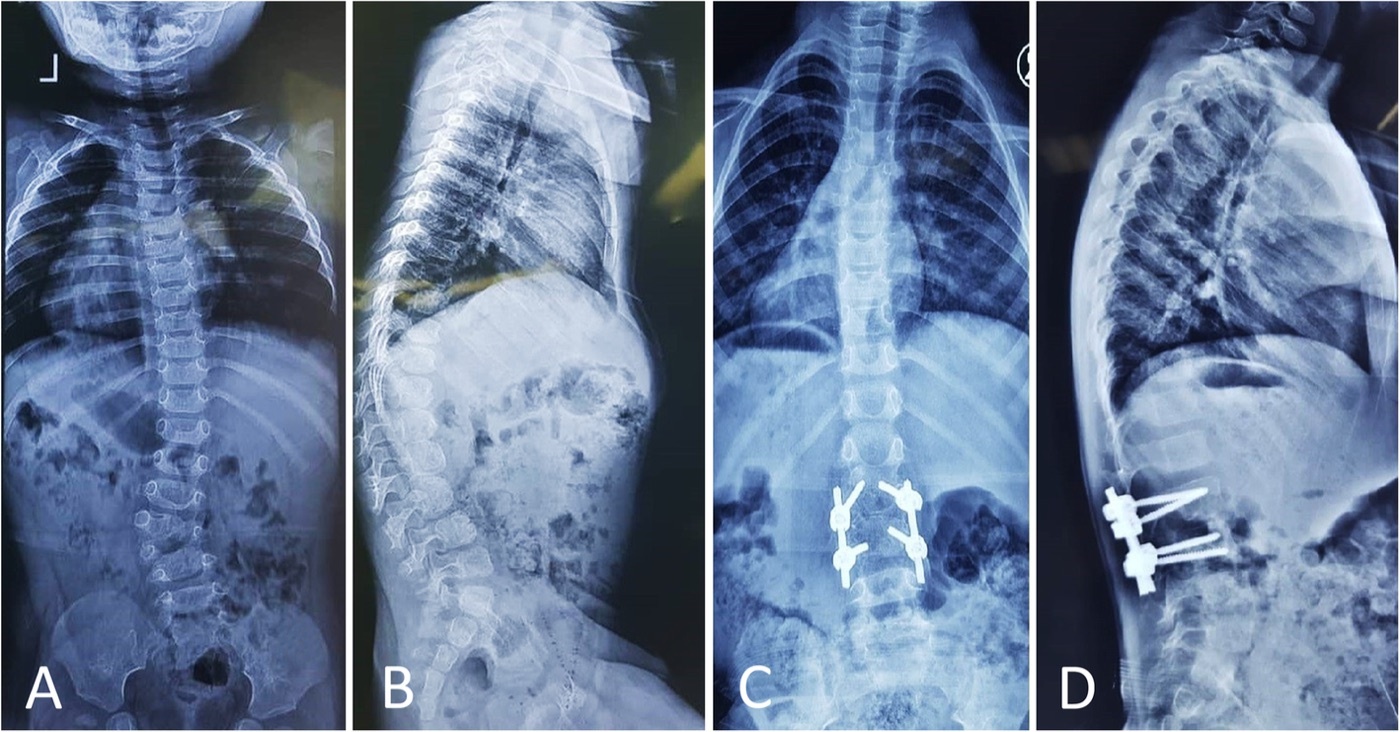 Congenital scoliosis from a lumbar hemivertebra. Standing antero-posterior (A) and lateral (B) radiographs of an 18-month-old boy with a fully segmented lumbar hemivertebra producing a 39° congenital curve; (C, D) after posterior instrumented correction. Zarei M et al., J Orthop Surg Res 2021;16:271, Fig. 3 (CC BY 4.0).