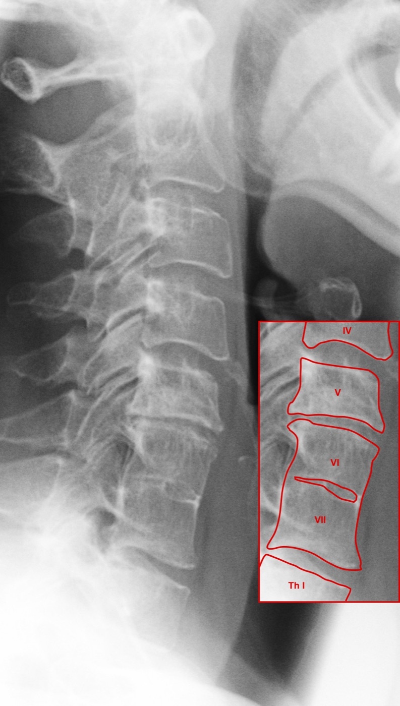 Klippel-Feil syndrome. Lateral cervical radiograph; the annotated inset marks congenital fusion at C6-C7 (vertebrae VI-VII), with the disc space obliterated. Dr. Jochen Lengerke, Wikimedia Commons (File:Klippel osteoch.jpg; licence “Copyrighted free use” - freely reusable, not a named Creative Commons licence).