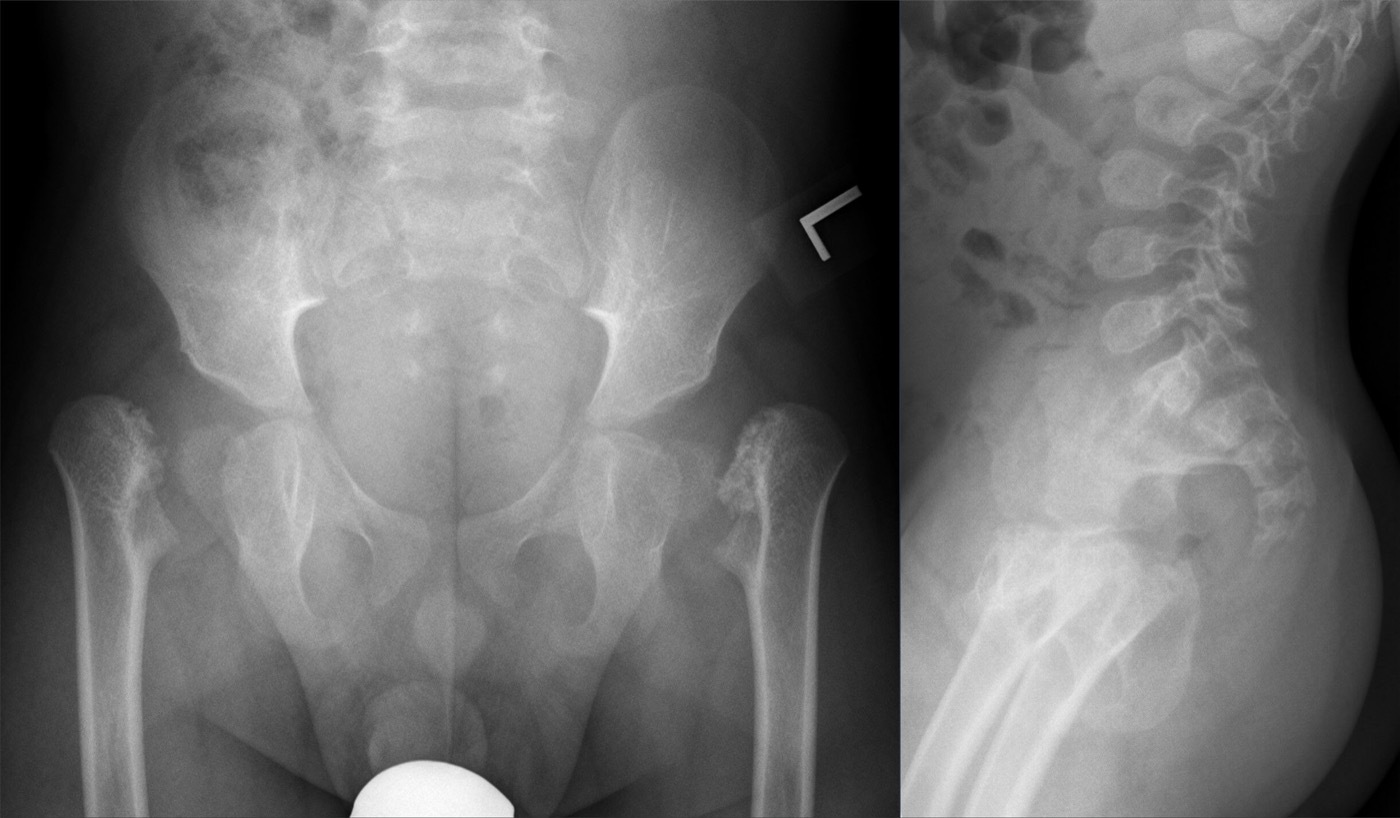 Bilateral coxa vara in a skeletal dysplasia. Antero-posterior pelvis (left) showing bilateral coxa vara with vertical proximal-femoral physes, and a lateral spine (right) with ovoid vertebrae, in spondyloepiphyseal dysplasia. Hellerhoff, Wikimedia Commons (CC BY-SA 4.0).
