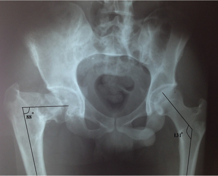 Secondary coxa vara - the “shepherd’s crook” of fibrous dysplasia. Antero-posterior pelvis: the right proximal femur shows severe varus (neck-shaft angle 88°) with ground-glass change, against a normal 131° on the left. Pathak SK et al., Cureus 2021;13(7):e16485, Fig. 2 (CC BY).