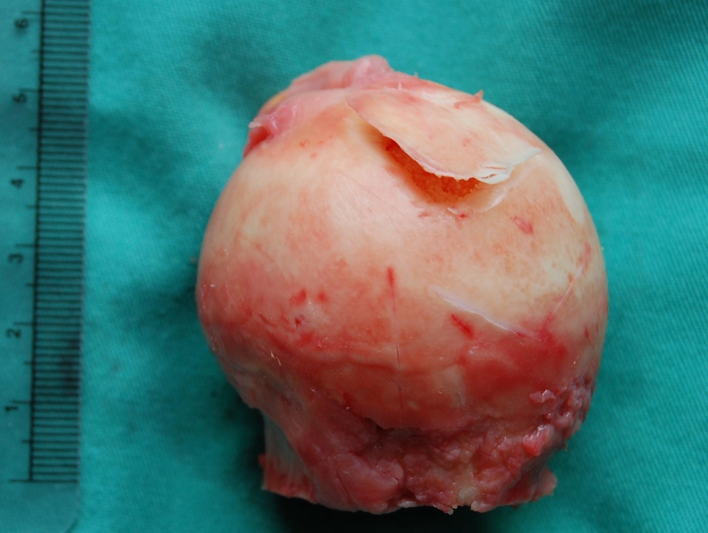 Avascular necrosis as a cause of secondary OA. Excised femoral head with a loose flap of articular cartilage overlying necrotic subchondral bone, the gross correlate of osteonecrosis progressing to arthrosis. Steven Fruitsmaak, via Wikimedia Commons, CC BY-SA 3.0.