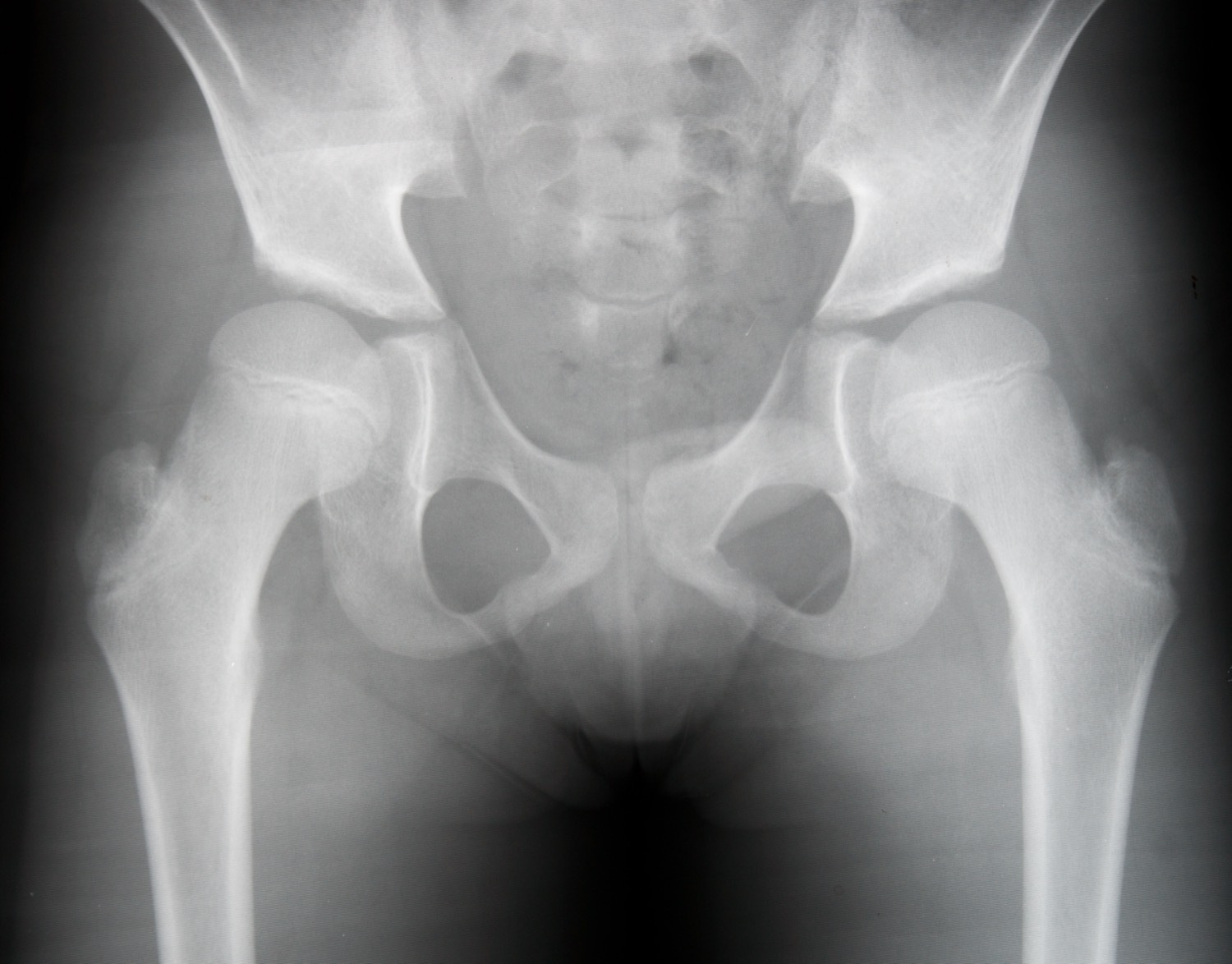 Antero-posterior pelvis of a child with developmental dysplasia of the right hip (pre-operative): the right proximal femur is small and high-riding with a shallow, steep acetabular roof, compared with the better-seated left hip. (Wikimedia Commons, “Login jetable”; CC0.)