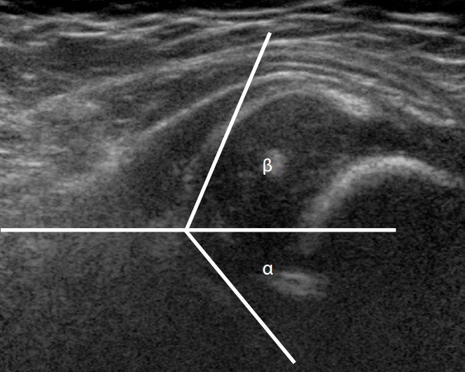 Coronal infant hip ultrasound of a dysplastic hip (Graf ≈ IIc; α 46°, β 65°) with the α/β construction lines: the bony roof is shallow and the femoral head is laterally decentred. (Kang & Koo, Ultrasonography 2017;36(4), Fig. 7; CC BY-NC 3.0 - non-commercial.)