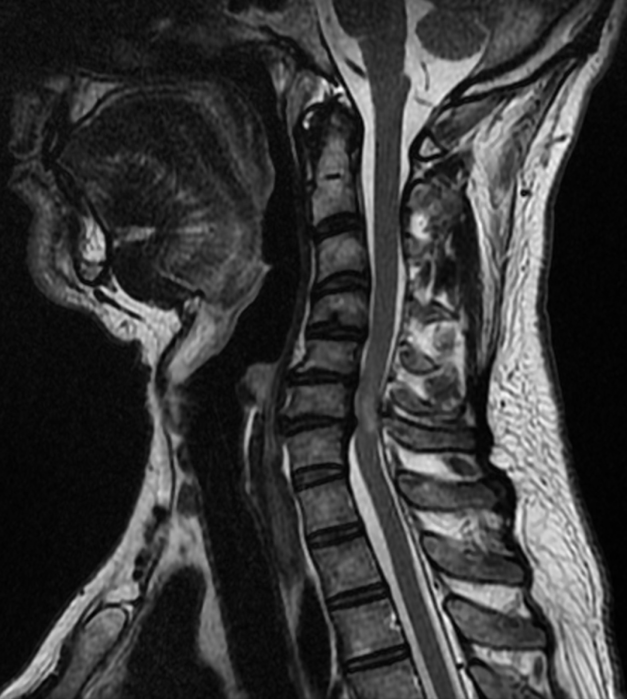 Cervical spondylotic myelopathy. Sagittal T2 cervical MRI with cord compression at a lower-cervical level. Jmarchn, Wikimedia Commons, CC BY-SA 3.0.