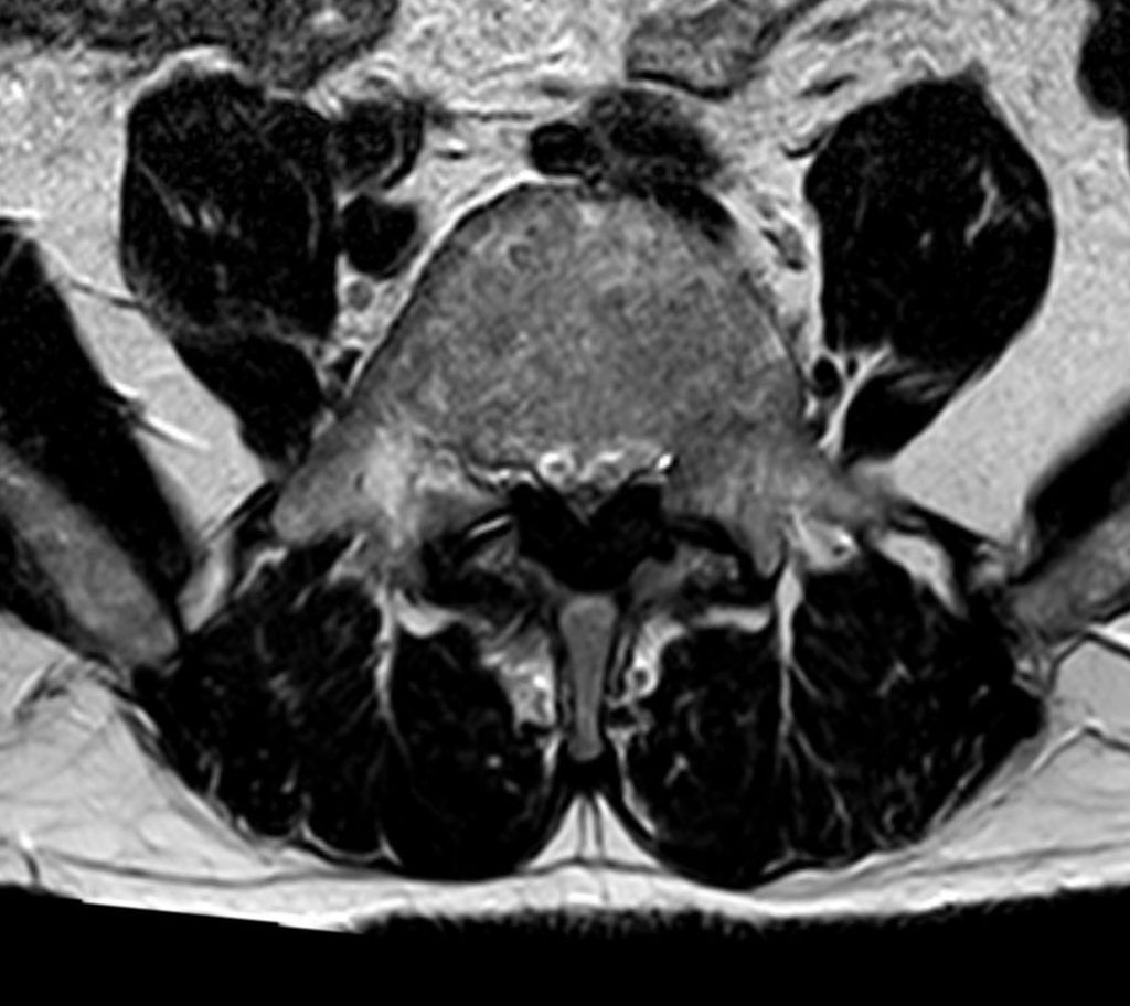 Lumbar central-canal stenosis. Axial T2 MRI: ligamentum-flavum hypertrophy narrowing the central canal. Hellerhoff, Wikimedia Commons, CC BY-SA 3.0.