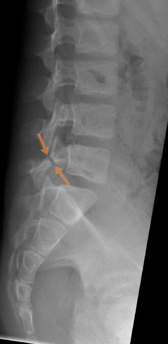 Spondylolysis. Lateral lumbar radiograph: a pars interarticularis defect (arrows). Kinderradiologie Olgahospital, Klinikum Stuttgart, Wikimedia Commons, CC BY-SA 4.0.