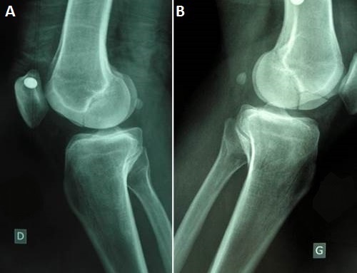 Figure 4. Hoffa fracture of the femoral condyle on the lateral radiograph, the view on which this coronal-plane fracture is best seen. Image by Koné et al., CC BY-SA 2.0, via Wikimedia Commons.