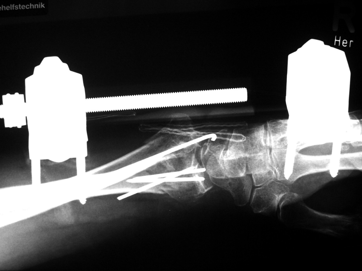 Figure 14. A comminuted distal radius fracture treated with a spanning (bridging) external fixator supplemented by K-wires. THWZ, via Wikimedia Commons, CC BY-SA 3.0.