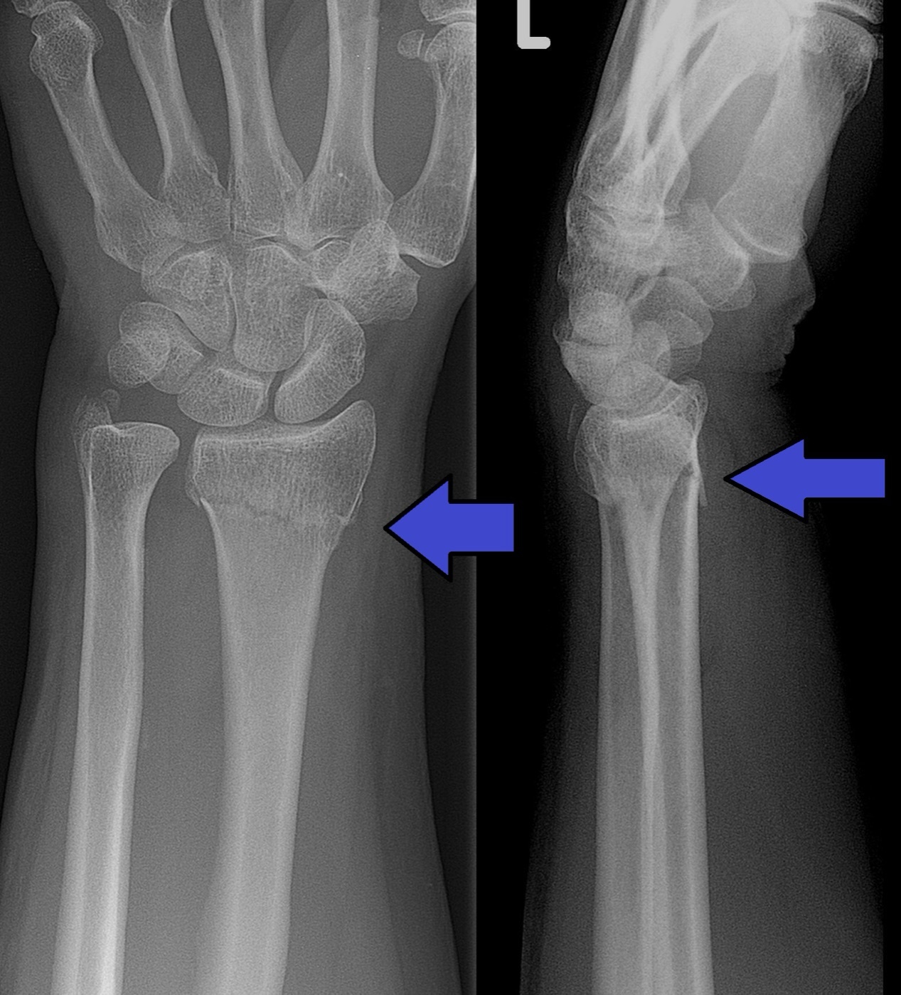 Figure 4. Colles fracture of the distal radius with an associated ulnar styloid fracture (AP and lateral views); the lateral shows the dorsal displacement of the dinner-fork deformity. Lucien Monfils, via Wikimedia Commons, CC BY-SA 3.0.