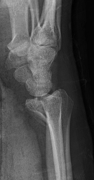 Figure 7. Volar (palmar) Barton fracture-dislocation of the distal radius (lateral view), an intra-articular rim fragment displaced with the carpus. Mikael Häggström, CC0 (public domain).